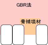 GBR法+インプラント