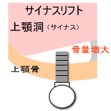 ソケットリフト法インプラント