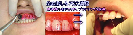 染め出し フロス掃除